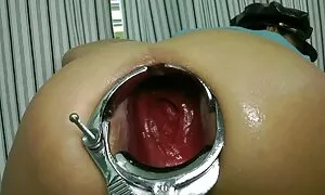 Speculum prolaps ak  ...
